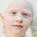Признаки альбинизма